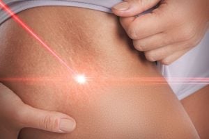 scar laser treatment park ridge IL